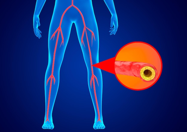 l-arteriopatia-periferica-e-l-accumulo-di-grasso-e-calcio-nelle-pareti-delle-arterie-degli-arti-inferiori-che-impediscono-il-flusso-sanguigno 59529-1652